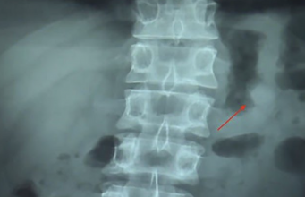 Muž spolkl AirPods. Divil se tomu, že v žaludku stále fungovaly